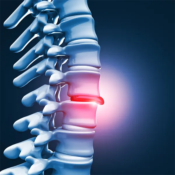 Disc Injury Treatment Near Me in Fargo, ND. Chiropractic Consultation for Disc Injury Pain Relief.